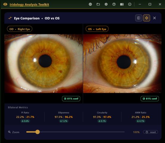 Side-by-side OD and OS comparison with bilateral metric deltas beneath