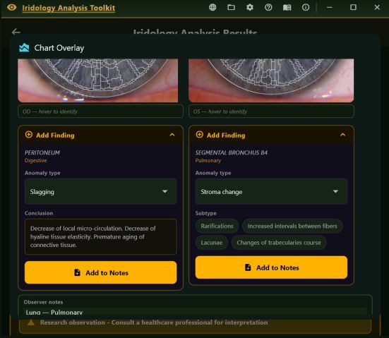 Add Finding panels for both eyes, each with an anomaly type dropdown, subtype chips and a generated conclusion, above an observer notes field