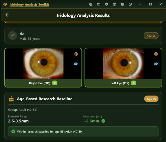 Results screen showing both eyes with confidence grades and an age-based research baseline