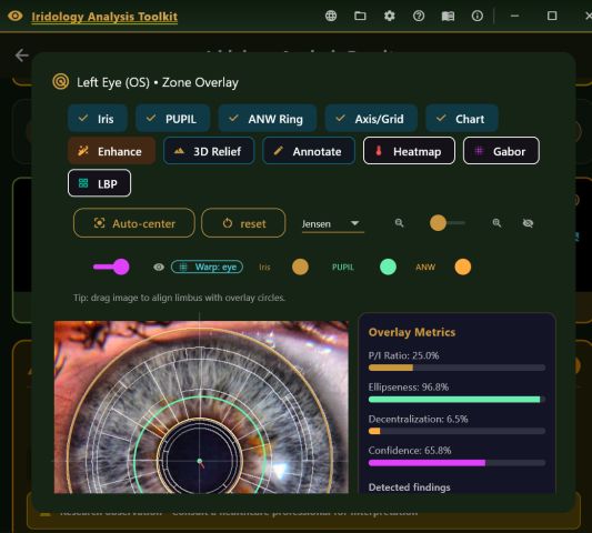 Zone overlay workspace with toggles for iris, pupil, ANW ring, grid and chart, and a live metrics panel
